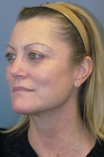 Face Lift/ Lite Lift 940943