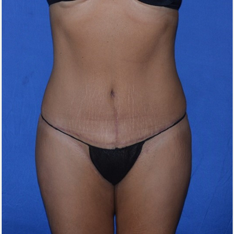 35-44 year old woman treated with No-Drain Tummy Tuck after 3655677