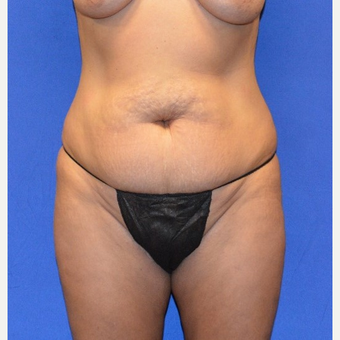 35-44 year old woman treated with No-Drain Tummy Tuck before 3655677