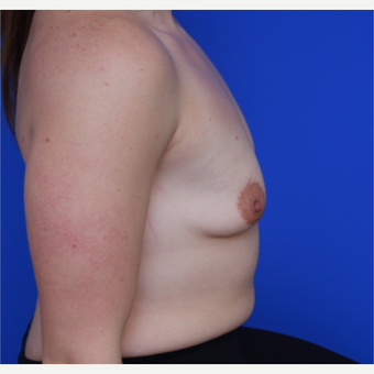 26- year old woman treated with Breast Augmentation before 3644076