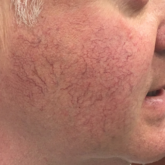 Nordlys Hybrid system to remove telangectasias of the cheeks - single treatment. before 3847562