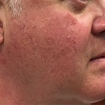 Nordlys Hybrid system to remove telangectasias of the cheeks - single treatment. after 3847562