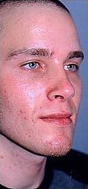 Rhinoplasty on 23-year-old after 953381