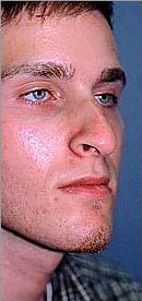 Rhinoplasty on 23-year-old before 953381