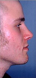 Rhinoplasty on 23-year-old 953381