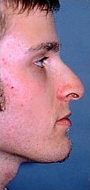 Rhinoplasty on 23-year-old 953381