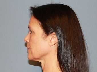 55 Year Old Minifacelift patient 1474871