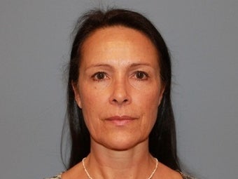 55 Year Old Minifacelift patient before 1474871