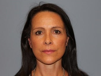 55 Year Old Minifacelift patient after 1474871