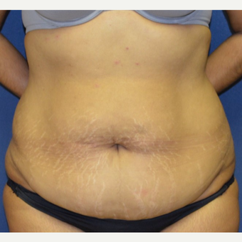 35-44 year old woman treated with Tummy Tuck before 3135269