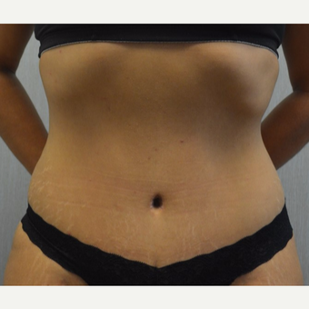 35-44 year old woman treated with Tummy Tuck after 3135269