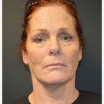 Woman treated with Kybella. After picture one month post only one Kybella treatment after 2030418