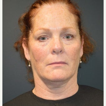 Woman treated with Kybella. After picture one month post only one Kybella treatment before 2030418