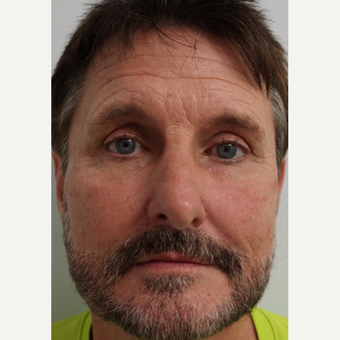 45-54 year old man treated with Bellafill for cheeks and tear trough after 3453445