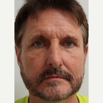 45-54 year old man treated with Bellafill for cheeks and tear trough before 3453445