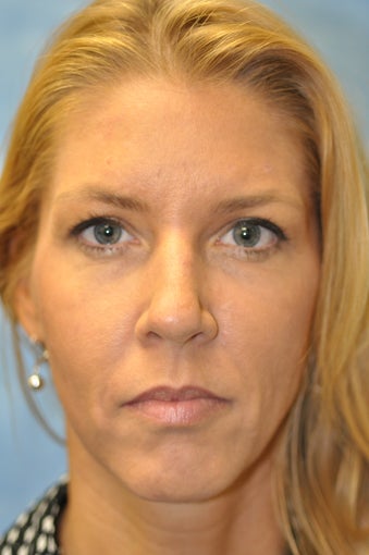 44 Year Old Female Treated for Unwanted Facial Lines after 1012730