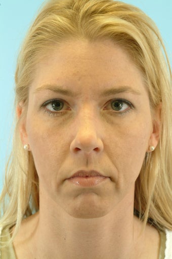44 Year Old Female Treated for Unwanted Facial Lines before 1012730