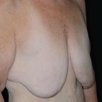 45-54 year old woman treated with Breast Reduction before 3810479
