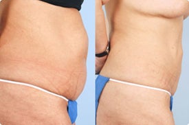 Smart Lipo: Abdomen before 989031