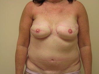 Breast Reconstruction after mastectomy after 1103515