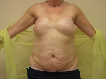 Breast Reconstruction after mastectomy before 1103515