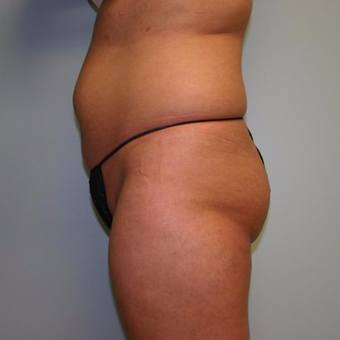 Brazilian Butt Lift before 3667422