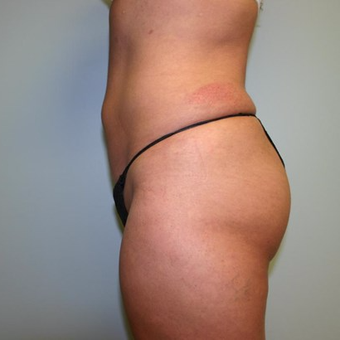 Brazilian Butt Lift after 3667422