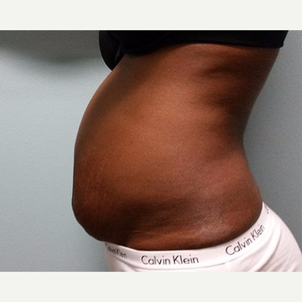 25-34 year old woman treated with Laser Liposuction before 3764253