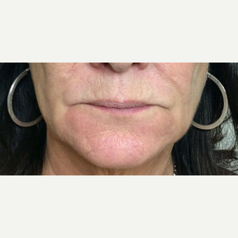 Lip Augmentation before 3065465