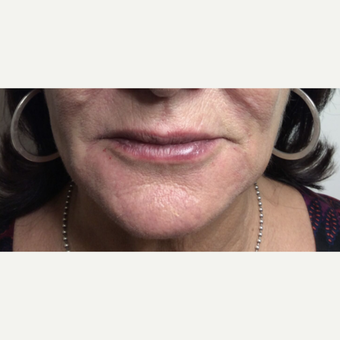 Lip Augmentation after 3065465