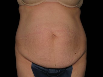 Abdominoplasty with 360 Circumferential Trunk SAFELipo before 1079760