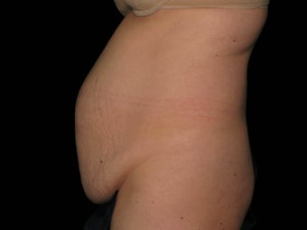 Abdominoplasty with 360 Circumferential Trunk SAFELipo 1079760