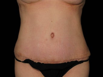 Abdominoplasty with 360 Circumferential Trunk SAFELipo after 1079760