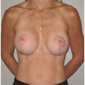 35-44 year old woman treated with Breast Implant Revision after 3666594
