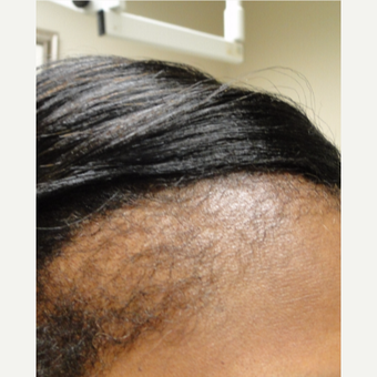 51 yr old female with 4 treatments also using Qilib before 3517852