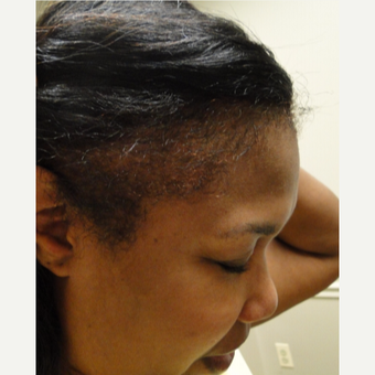 51 yr old female with 4 treatments also using Qilib after 3517852