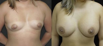 28 year old woman treated with Breast Augmentation before 3004719