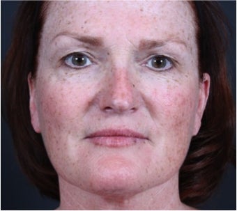 This 50 year old woman underwent laser skin resurfacing before 1317975