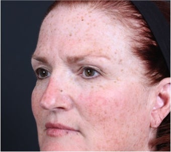 This 50 year old woman underwent laser skin resurfacing 1317975