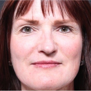 This 50 year old woman underwent laser skin resurfacing after 1317975