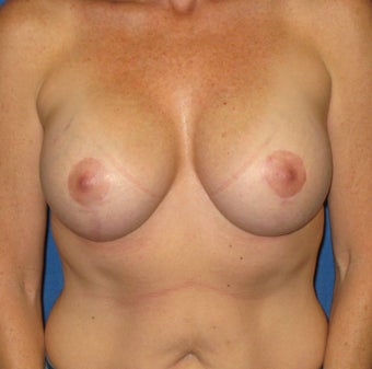 Bilateral short scar Breast Lift and placement of 350cc Moderate Plus profile after 941178