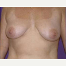 45-54 year old woman treated with Breast Lift before 3423771