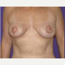 45-54 year old woman treated with Breast Lift after 3423771