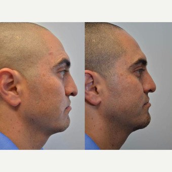 Rhinoplasty 35-44 year old man treated for crooked nose, difficulty breathing, flattened nasal tip after 3114359