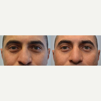 Rhinoplasty 35-44 year old man treated for crooked nose, difficulty breathing, flattened nasal tip before 3114359