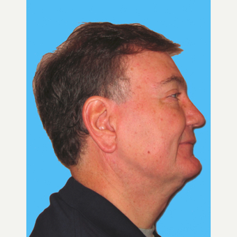 Neck Lift after 3824819
