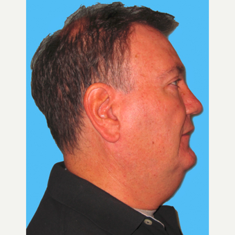 Neck Lift before 3824819