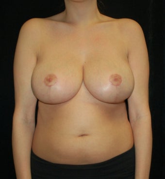 Breast Reduction Case after 731328