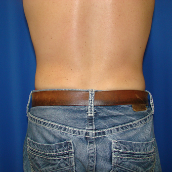 35-44 year old woman treated with Smart Lipo after 3593176