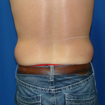 35-44 year old woman treated with Smart Lipo before 3593176